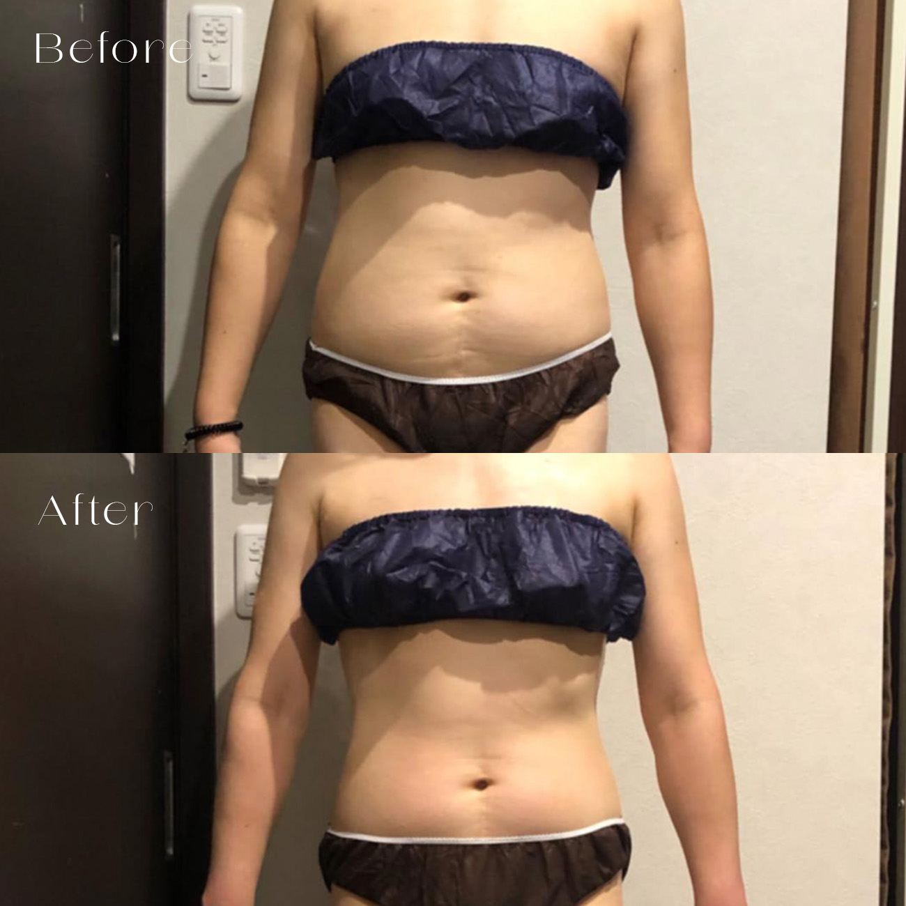施術例（痩身）｜BS AQUA Beauty 愛媛県松山市のトータルビューティー