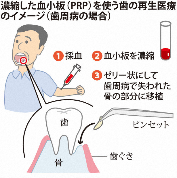歯の再生医療の安全性と効果は？順天堂大チームが臨床研究へ | 毎日新聞