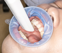 FEEDデンタル】オプトラゲートの通販｜開口器、ティッシュリトラクター