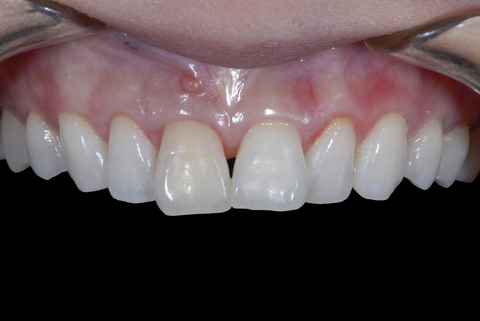 Interdental Papilla Reconstruction Surgery - Advanced Cosmetic