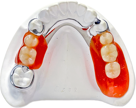 歯科技工物/デンチャー | 歯科技工所 コットンテール