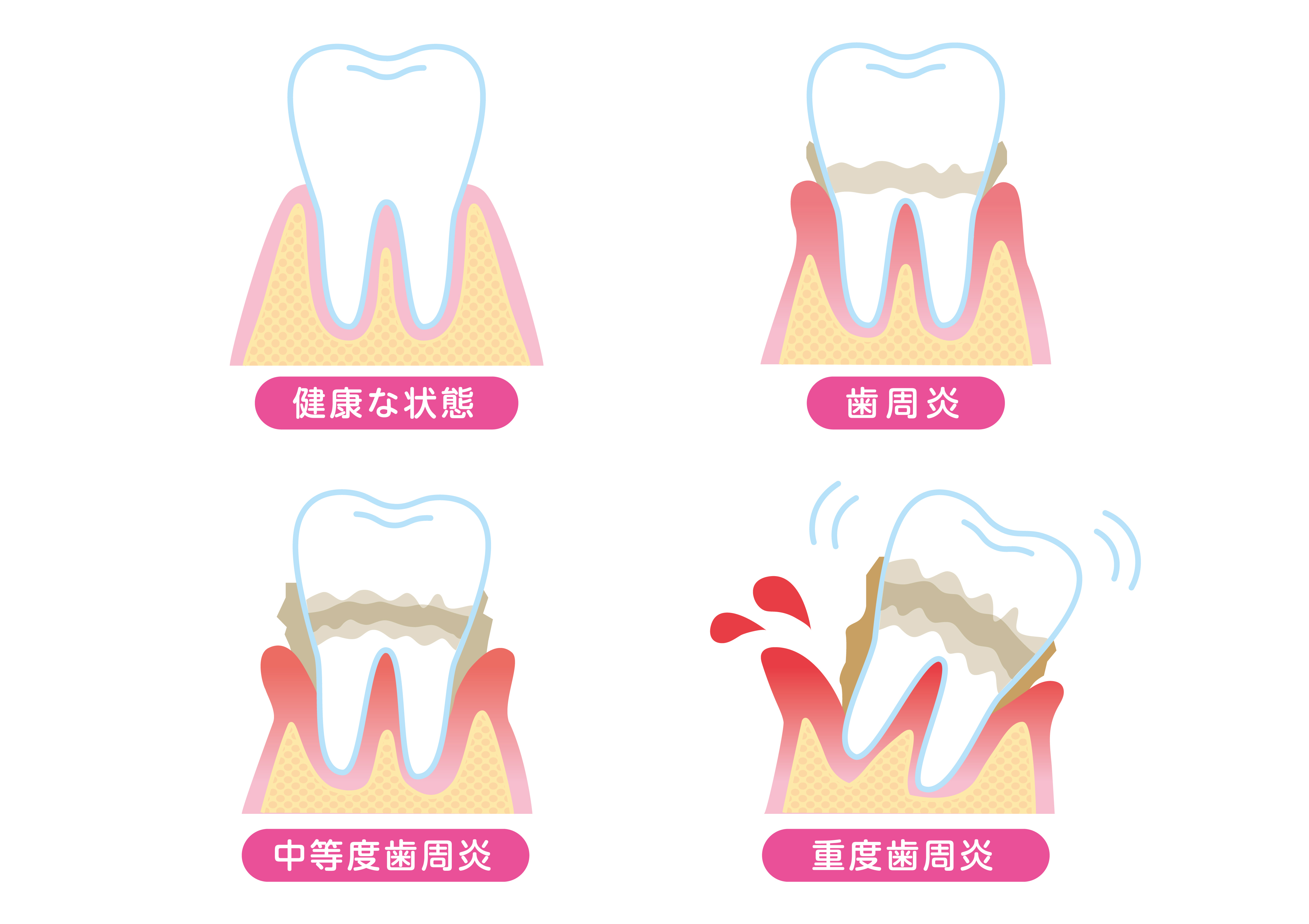 歯周病について