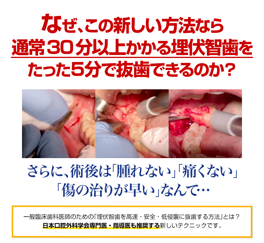 株式会社 医療情報研究所 | 超高速無痛抜歯～たった5分で埋伏智歯抜歯