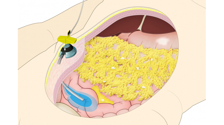 難治性がんの克服を目指して、東京大学 未来社会協創基金「スキルス
