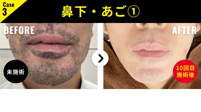 👑脱毛ビジネスのご案内👑 業務用脱毛機 LUMIX-A9X ルミクスエーナイン