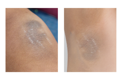 BBL搭載 ハイスペック業務用脱毛機 LUMIX-NO.V1A（ルミクス ノヴィア