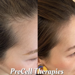 業務用育毛・スカルプケア｜プロセルセラピーズの特徴・効果・導入費用