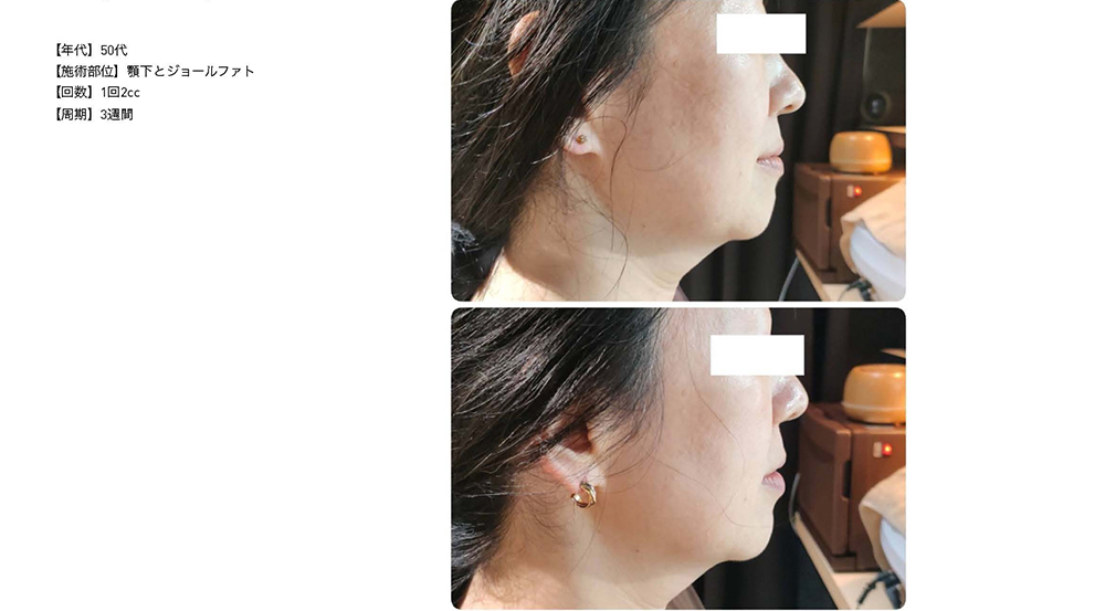 レモンボトル（10ml×5本）×5個セット 脂肪分解／脂肪溶解剤 - エステの