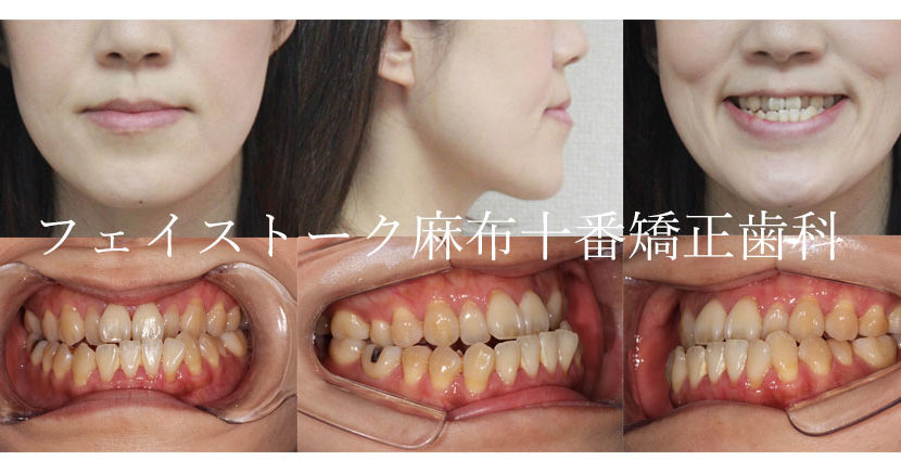 受け口（反対咬合）の矯正歯科治療 | 医療法人社団 FACE AND SMILE