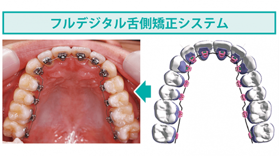 No.111 進化した舌側矯正 ハーモニーとは？ | ふかつ歯科・矯正歯科