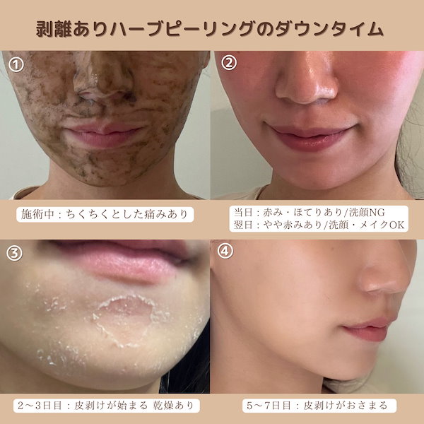 Qoo10] DAPPY（剥離ありハーブピーリング2回