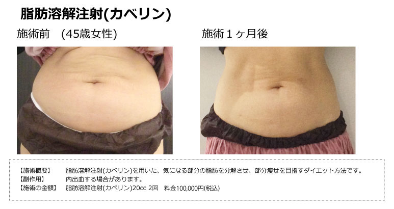 脂肪溶解注射(カベリン) | 銀座for youクリニック