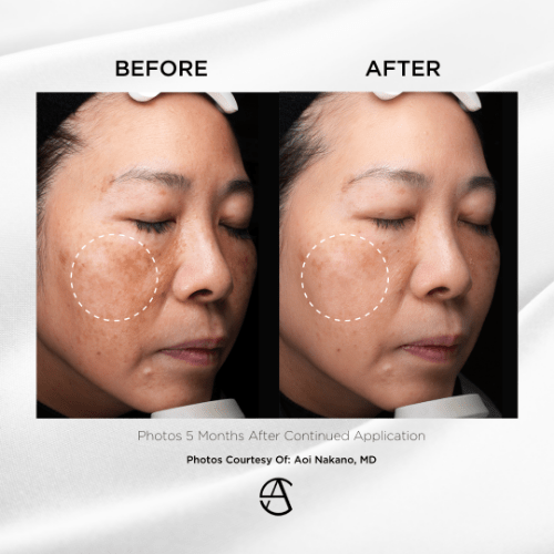 メラブライトC+｜シミの原因メラニンを抑制するシステアミン配合の美容