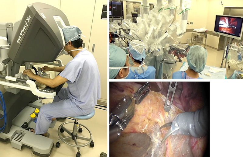 大腸がんは「おとなしいがん」！ 早期なら内視鏡で切除、ロボット手術