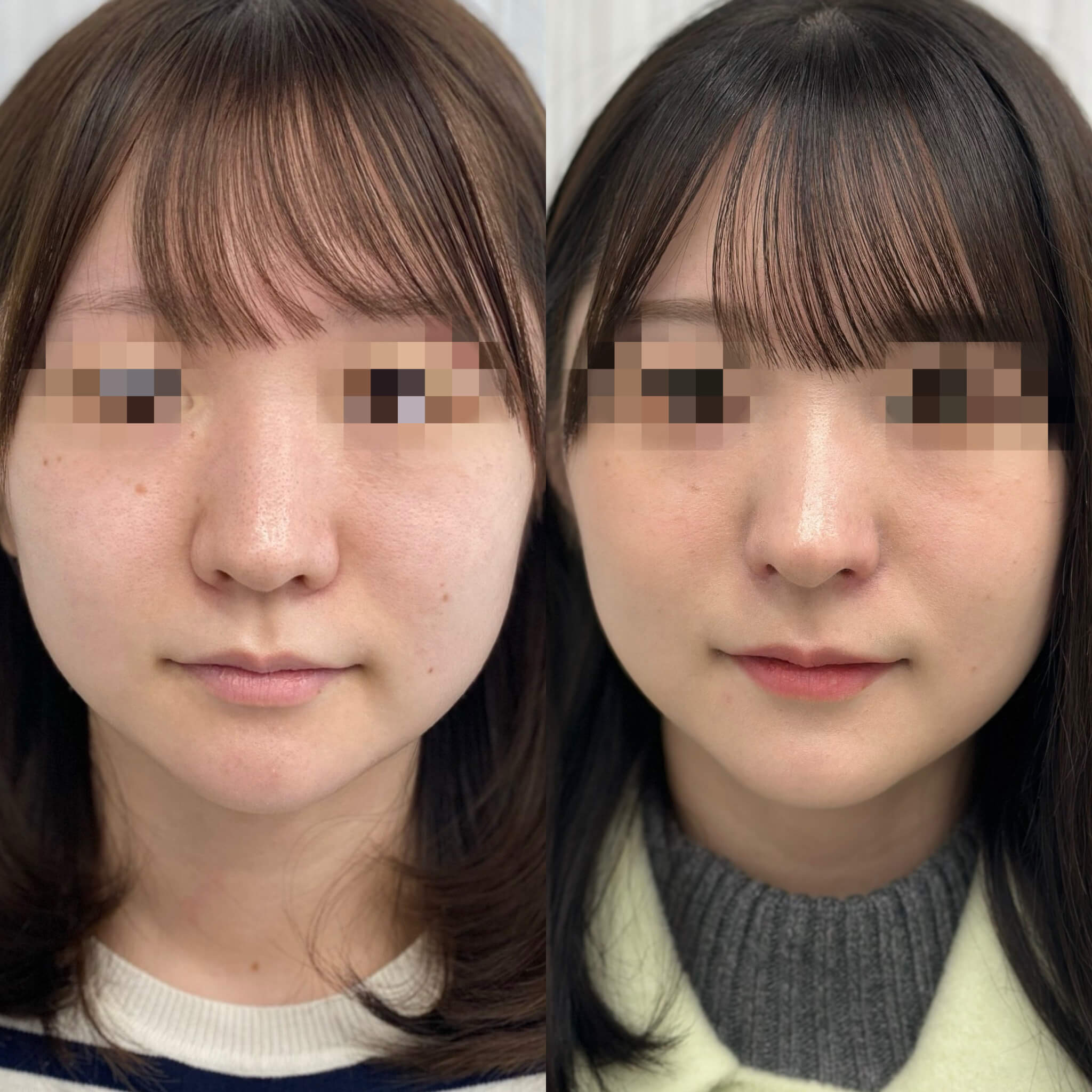 鼻孔縁挙上なら東京にあるグランツクリニックへ