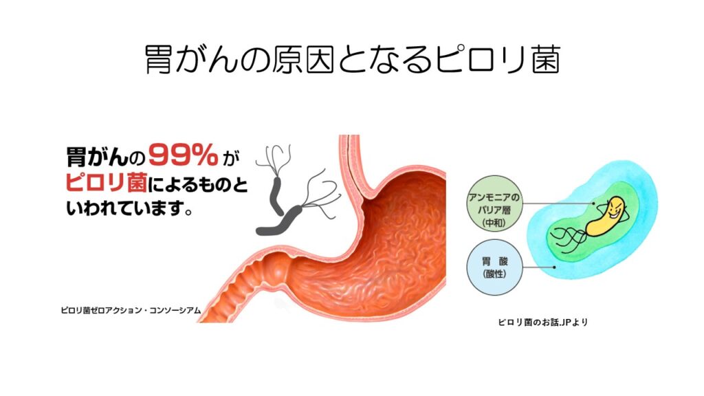 胃がん最新治療を全解説 / 内視鏡手術 / 胃切除術 / ピロリ菌 / 免疫