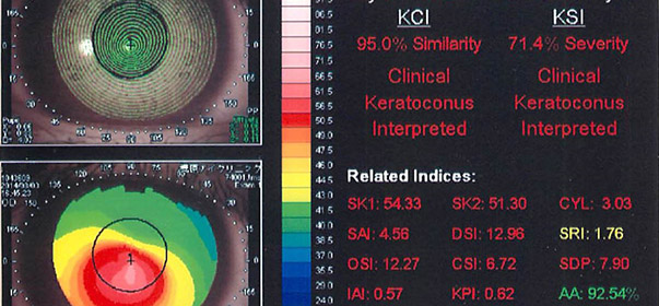 円錐角膜の治療 | 福岡市天神の眼科 | 梶原アイクリニック