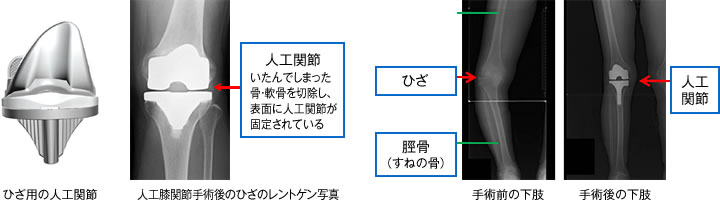 人工膝（ひざ）関節手術とは | 北水会記念病院 膝関節専門外来