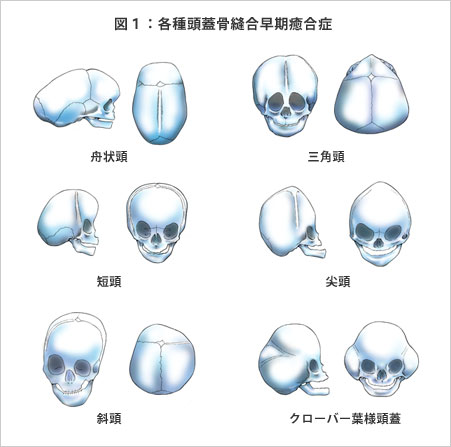 形成外科｜頭蓋骨縫合早期癒合症（狭頭症）治療・手術｜順天堂大学