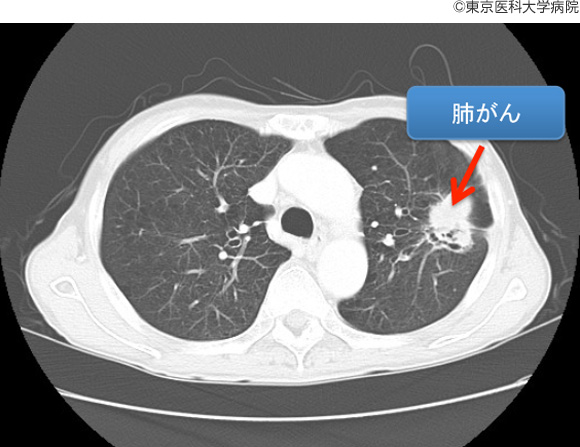 肺がんの基礎知識｜肺がん -西新宿の地で がんに挑む- 東京医科大学病院