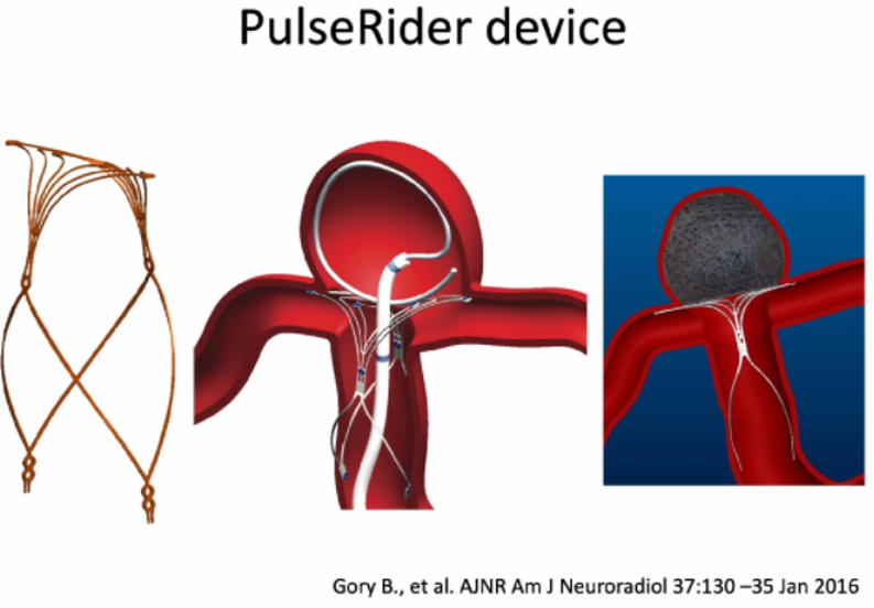 脳神経外科 未破裂脳動脈瘤コイル塞栓術100のテクニック 未破裂脳動脈