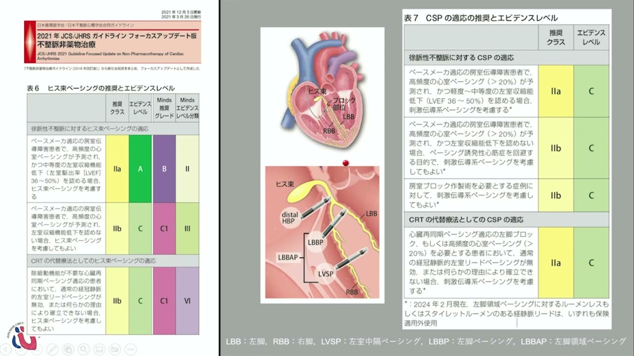 2024年JCS/JHRS ガイドライン フォーカスアップデート版 不整脈治療