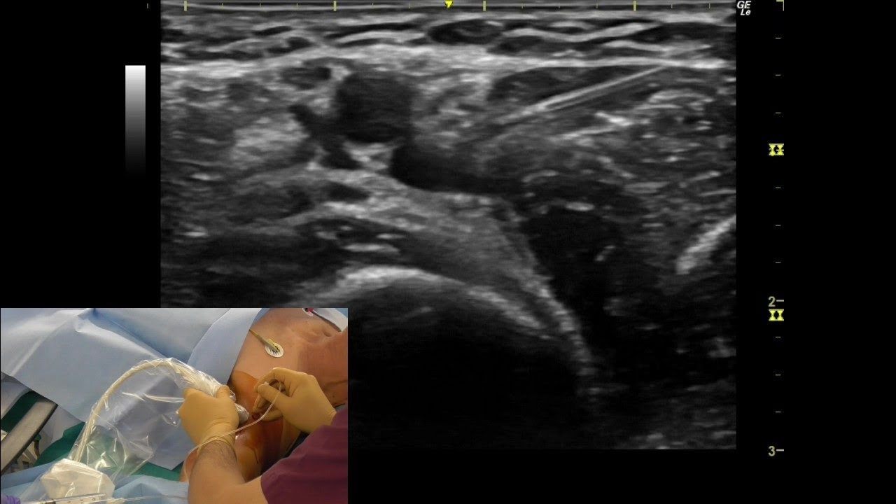 神経ブロック】腕神経叢ブロック(腋窩アプローチ)_エコーガイド下