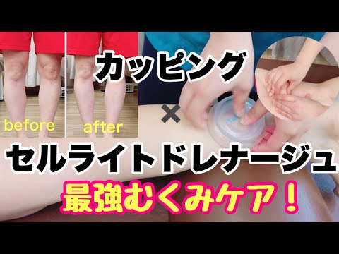 セルライト 除去】『カッピング×セルライトドレナージュ 最強のむくみ