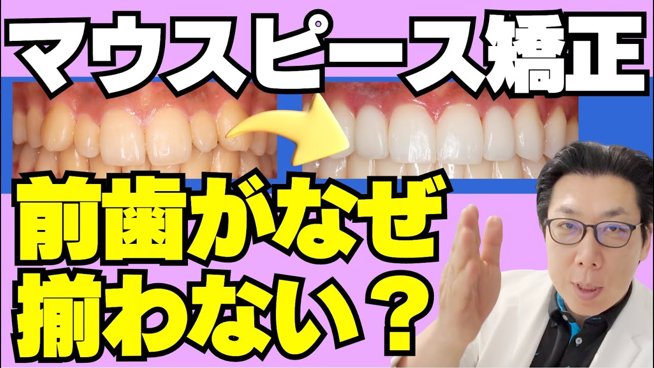 矯正治療をしても前歯が揃って見えない！？アライナー矯正治療だけで