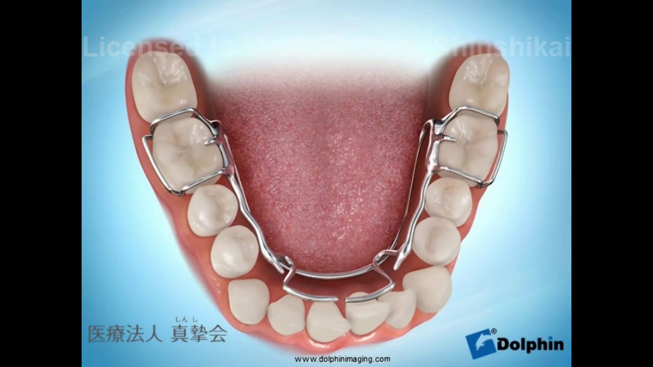 固定式の急速拡大装置を使った子どもの顎顔面矯正｜大阪矯正歯科グループ