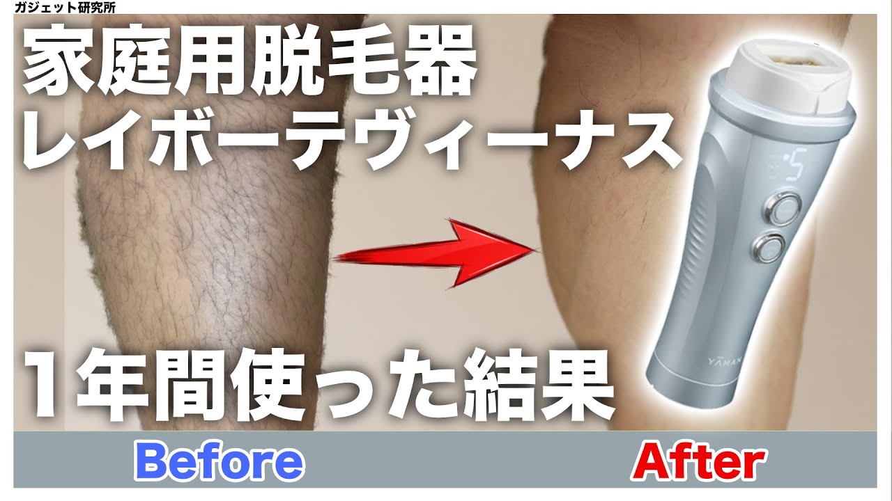 Results of using the Rei Beaute Venus home hair removal device for