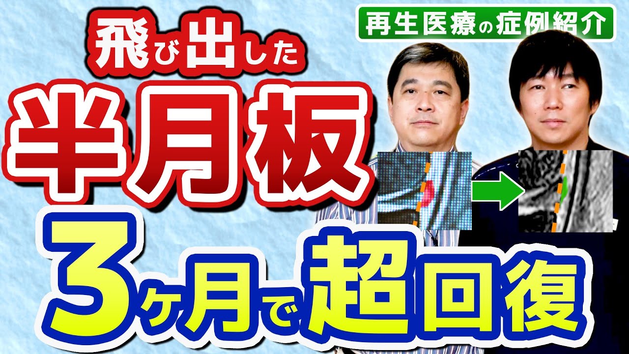 再生医療】飛び出た半月板が3ヶ月で回復！実際の症例をレントゲンとMRI