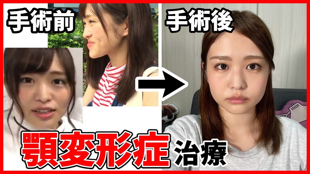 手術後、初めてお顔を公開します。【顎変形症】【下顎前突】 - YouTube