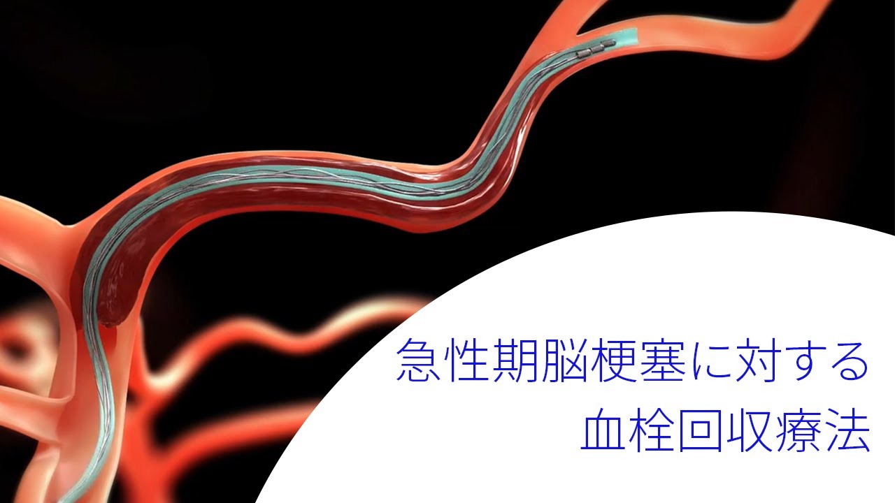 急性期脳梗塞に対する血栓回収療法 - YouTube