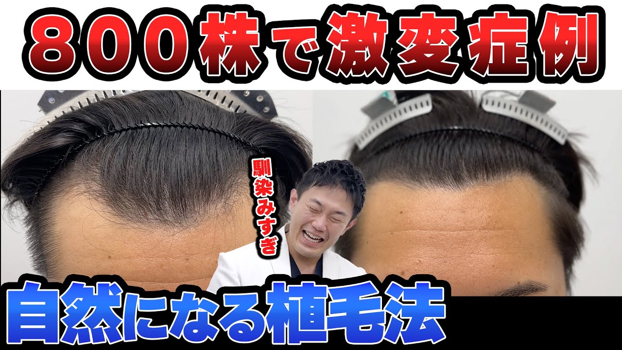 映像付き】自毛植毛でM字が自然になったヤバすぎる症例経過を解説