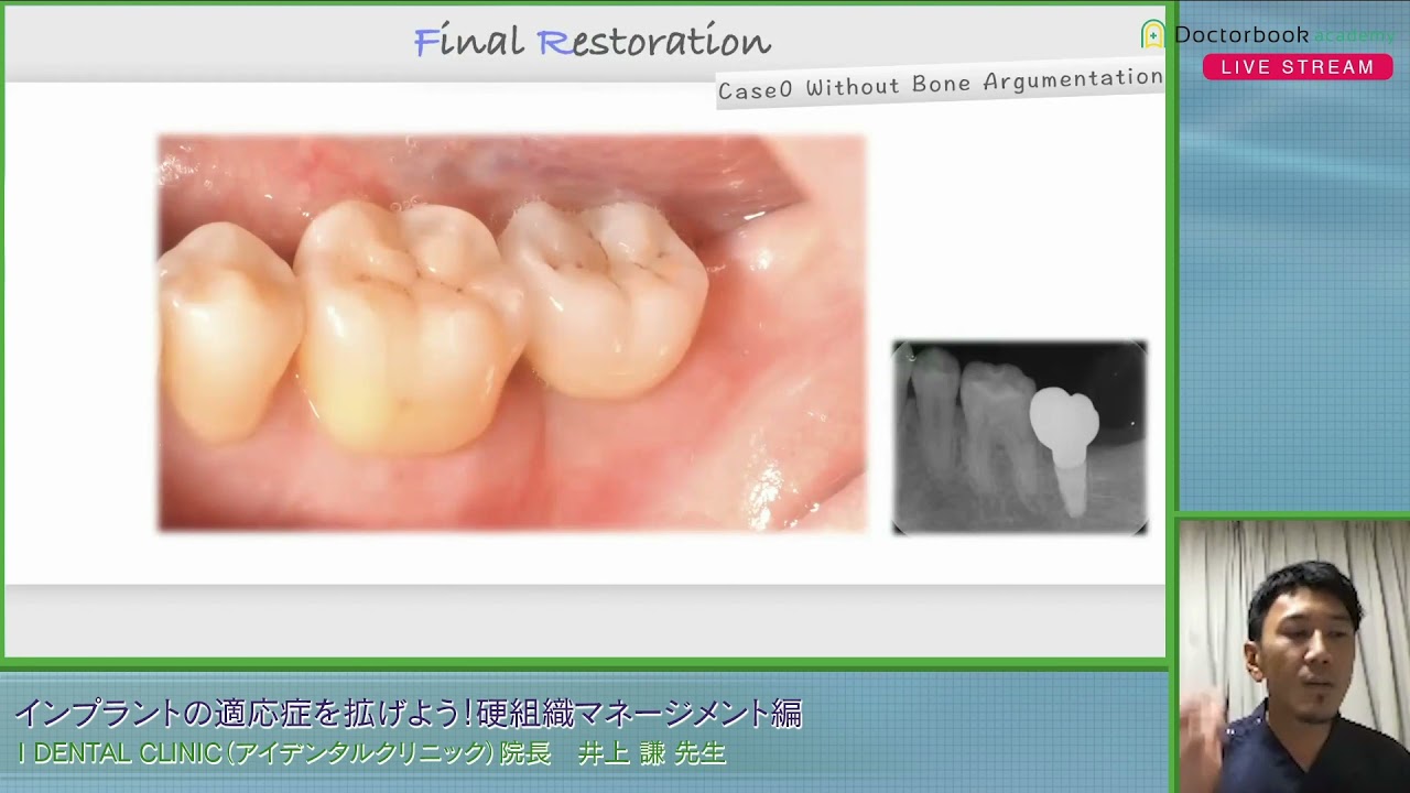 インプラントの適応症を拡げよう！ ～硬組織マネージメント編～ - YouTube