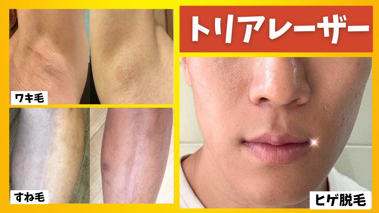 5 Years Later] Why is Tria the Best Hair Removal Device? A Home