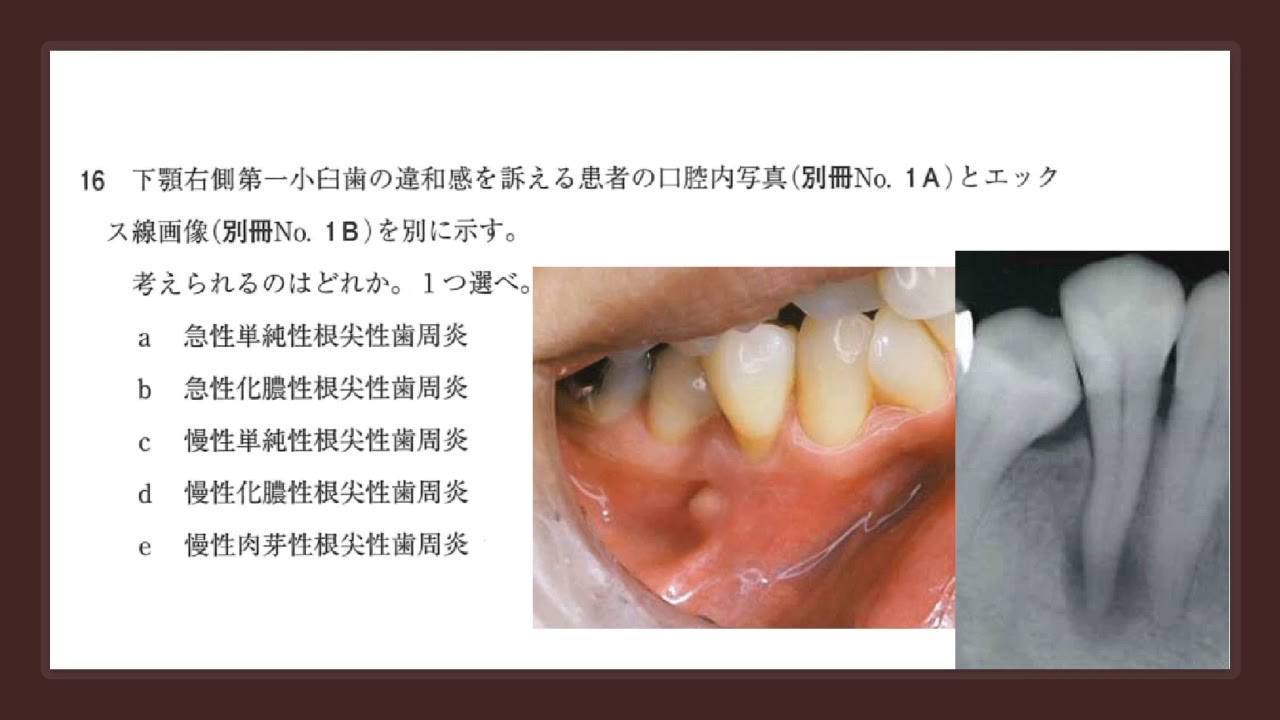 第113回歯科医師国家試験 必修全80問 ロムニーハウス勉強会 - YouTube