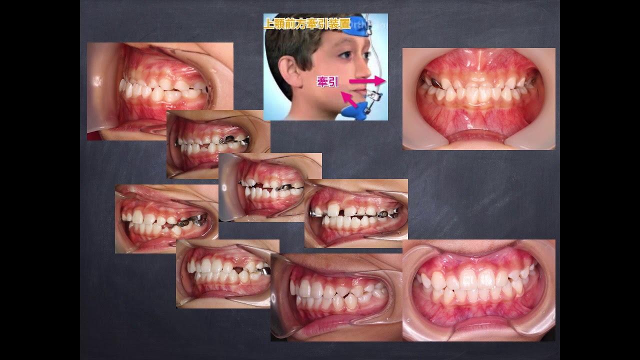 顎顔面矯正 ｜ 横浜市 港南区 吉田歯科クリニック