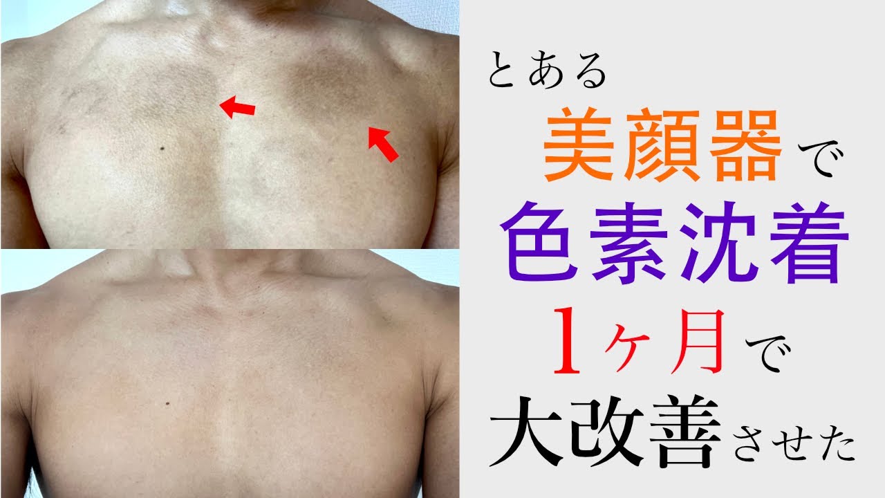 tria スキン エイジング アイケアレーザー 動作確認済 目のくま