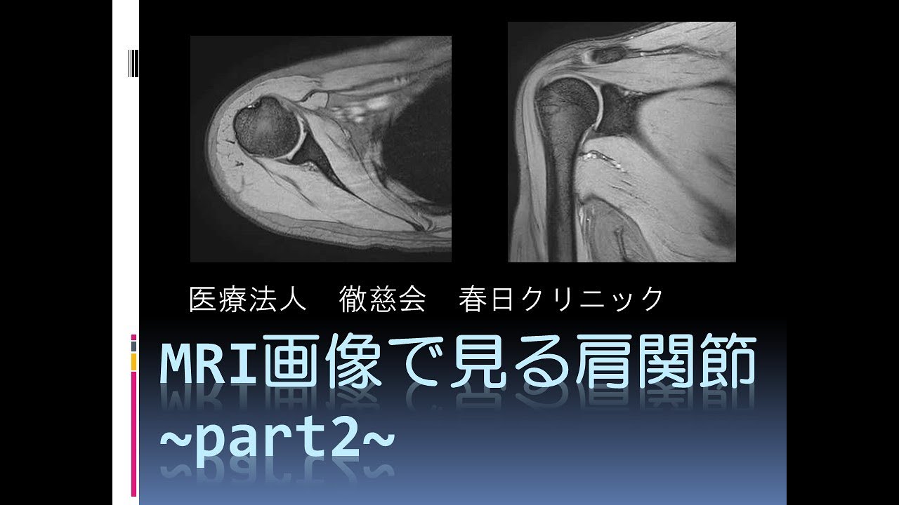 春日クリニック】MRIで見る肩関節part2 - YouTube