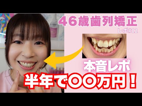 46歳からの歯列矯正】半年経過！リアルな変化&費用を本音レポ - YouTube