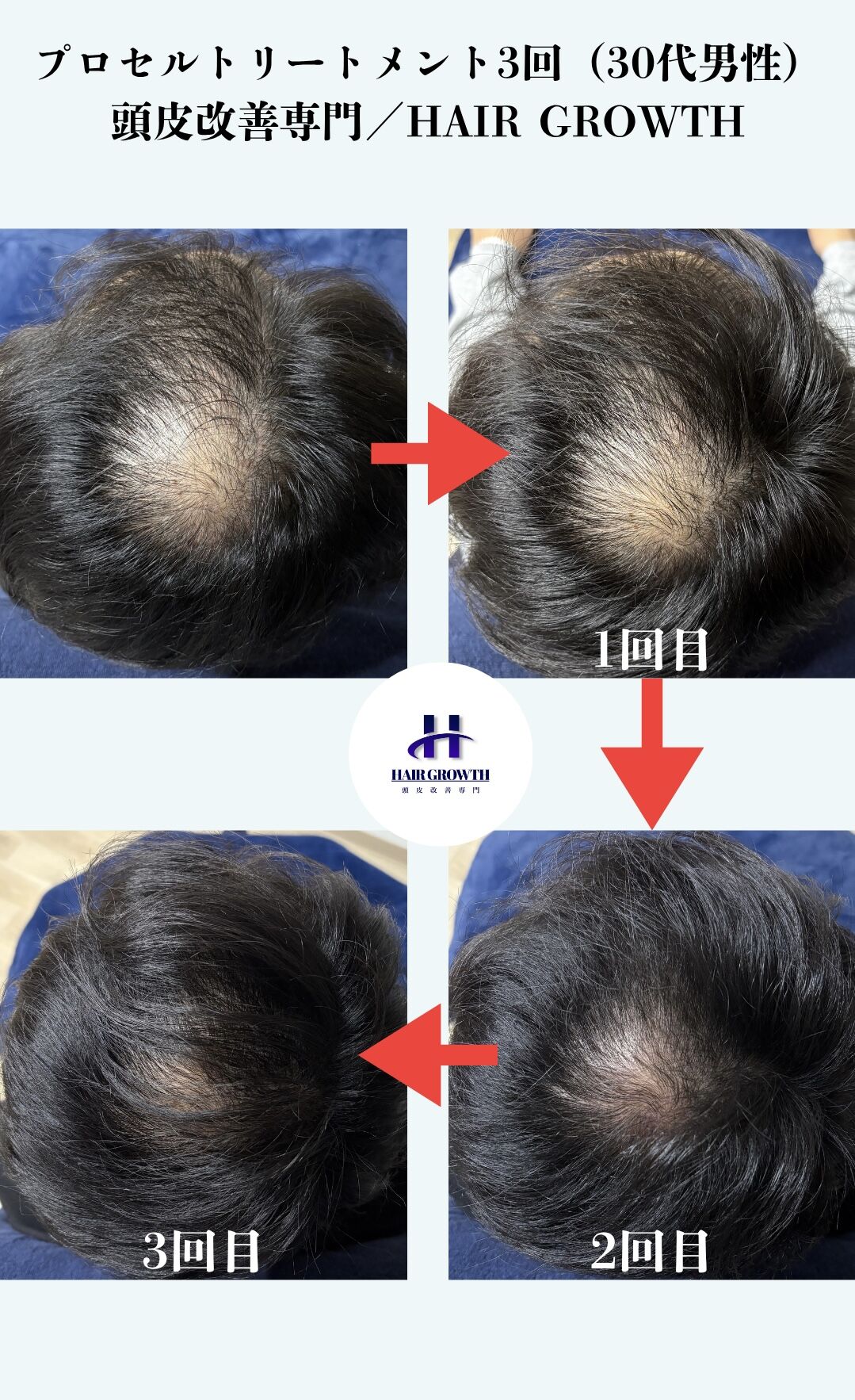 プロセルセラピーズ　頭皮用美容液　5ml×2本