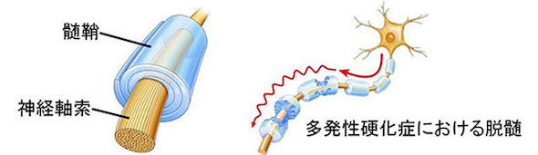 脳脊髄の髄鞘再生をMRIで可視化する手法を開発：医療技術ニュース
