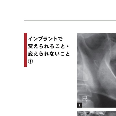 欠損歯列」の読み方,「欠損補綴」の設計