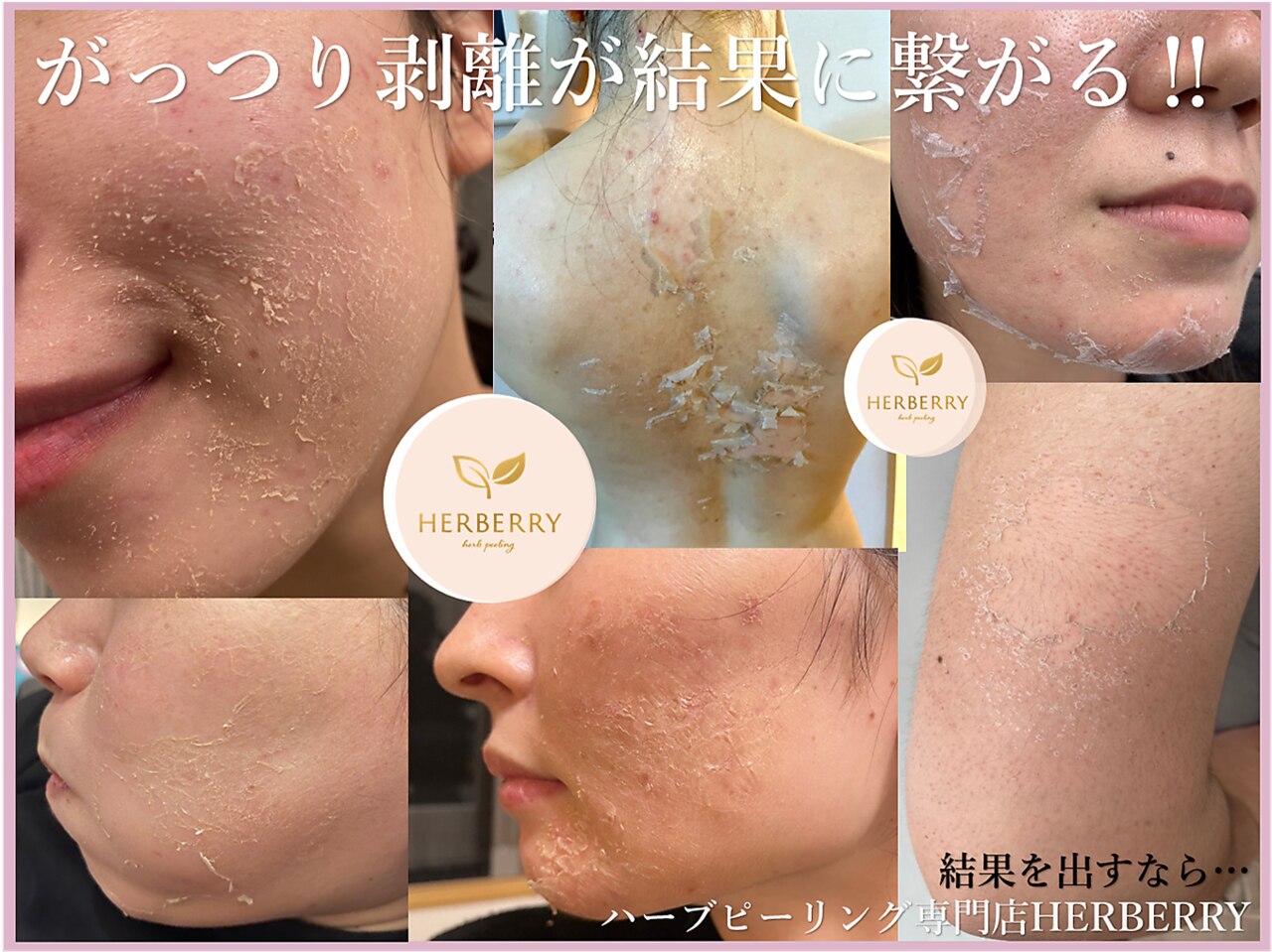 専用ハーブピーリング剥離無し 10回分（11月11日から2月20日の間発送