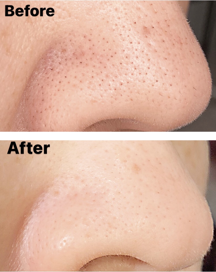 毛穴洗浄【ハイドロスプラッシュ】｜メンズ脱毛・ハイパーナイフなら