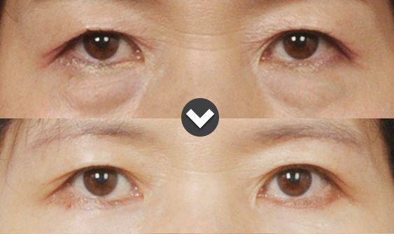 下眼瞼手術で目の下のたるみ改善 : id美容外科