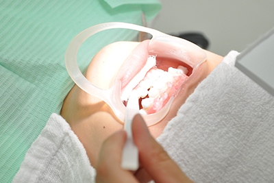 ホワイトニング | かさいエキ総合歯科