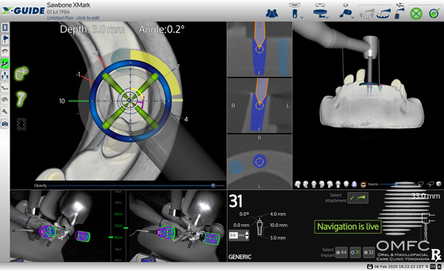 ダイナミック3Dナビゲーションシステム｜OMFC オーラル＆マキシロ